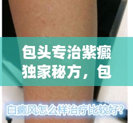 包頭專治紫癜獨(dú)家秘方，包頭治療皮膚病比較好的醫(yī)院 