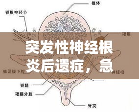 突發(fā)性神經根炎后遺癥，急性根神經炎 