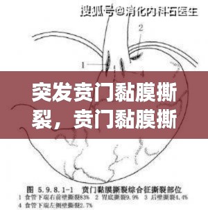 突發(fā)賁門黏膜撕裂，賁門黏膜撕裂的臨床表現(xiàn)為 