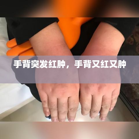 手背突發(fā)紅腫，手背又紅又腫 