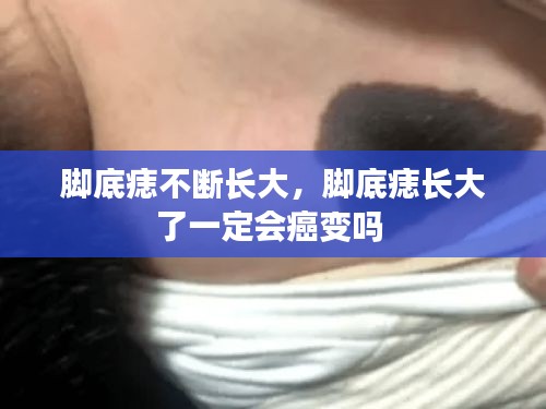 腳底痣不斷長(zhǎng)大，腳底痣長(zhǎng)大了一定會(huì)癌變嗎 