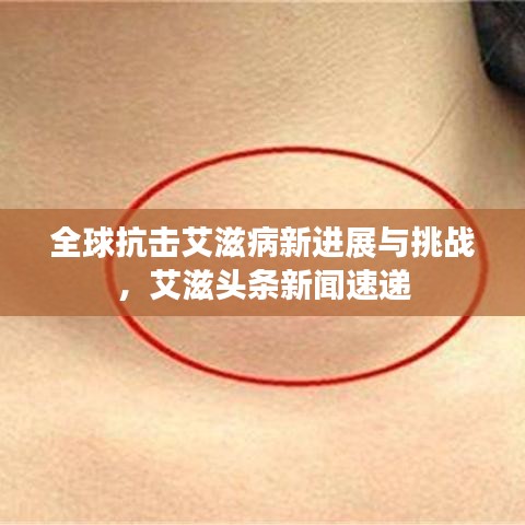 全球抗擊艾滋病新進展與挑戰(zhàn)，艾滋頭條新聞速遞