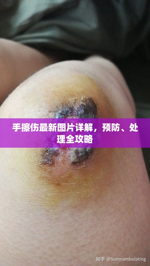 手擦傷最新圖片詳解，預(yù)防、處理全攻略