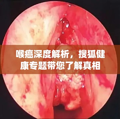 喉癌深度解析，搜狐健康專題帶您了解真相